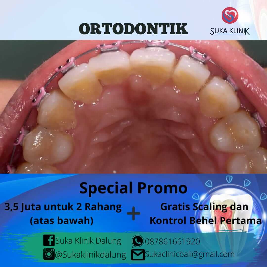 Promo Ortodontik Gigi Dalung Badung Bali Suka Klinik