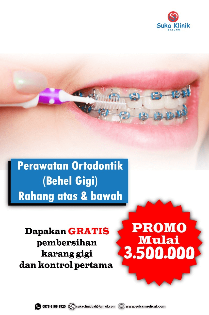 Promo Perawatan Ortodontik Behel Gigi Rahang Atas dan Bawah